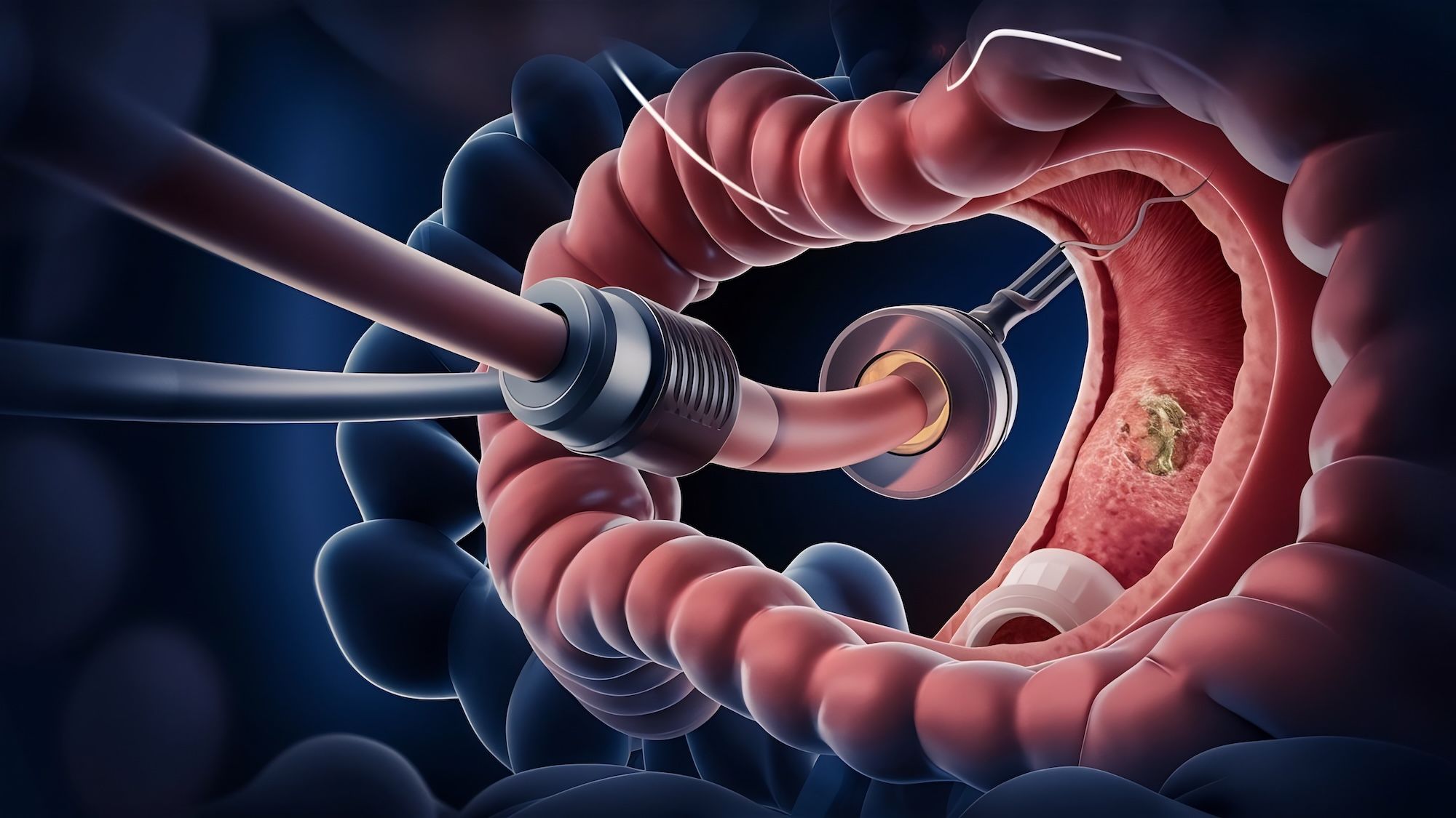 colonoscopy-technology-with-endoscope-inside-intestine-with-polyp.jpg